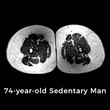 the unhealthy thighs of a 74 year old sedentary man.